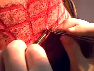 scarification